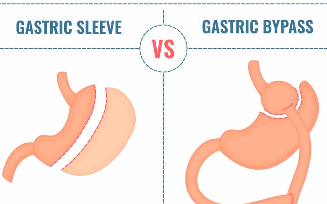 Total Medical Surgical Weight Loss compares Gastric Sleeve (Sleeve Gastrectom) and Gastric Bypass surgeries