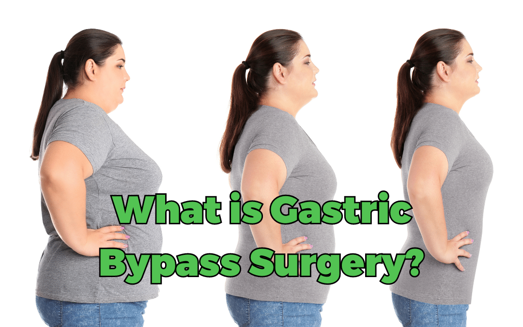 What is Gastric Bypass Surgery?
